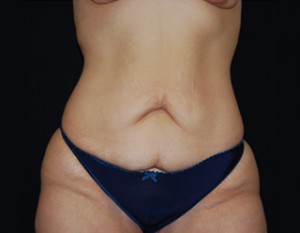 Tummy Tuck Before & After Patient #19985