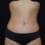 Tummy Tuck Before & After Patient #19985