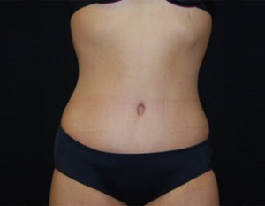 Tummy Tuck Before & After Patient #19985