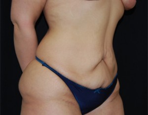 Tummy Tuck Before & After Patient #19985