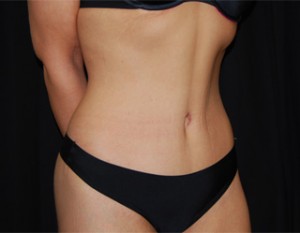 Tummy Tuck Before & After Patient #19985