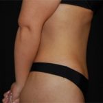 Tummy Tuck Before & After Patient #19985