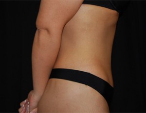 Tummy Tuck Before & After Patient #19985