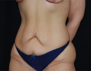 Tummy Tuck Before & After Patient #19985