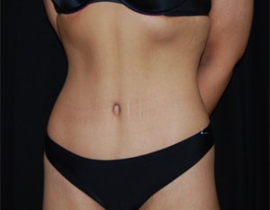 Tummy Tuck Before & After Patient #19985