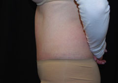 Tummy Tuck Before & After Patient #24404