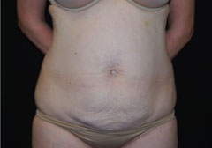 Tummy Tuck Before & After Patient #24404