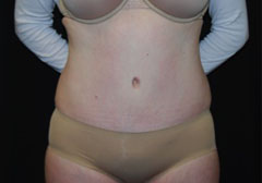 Tummy Tuck Before & After Patient #24404