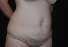 Tummy Tuck Before & After Patient #24404