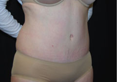 Tummy Tuck Before & After Patient #24404