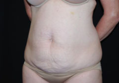 Tummy Tuck Before & After Patient #24404
