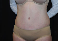 Tummy Tuck Before & After Patient #24404