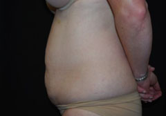 Tummy Tuck Before & After Patient #24404