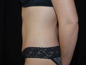 Tummy Tuck Before & After Patient #24425