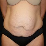 Tummy Tuck Before & After Patient #24425