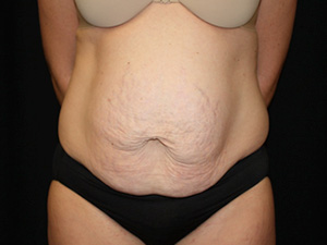 Tummy Tuck Before & After Patient #24425