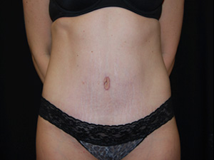 Tummy Tuck Before & After Patient #24425