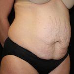 Tummy Tuck Before & After Patient #24425