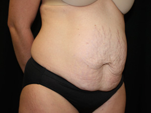 Tummy Tuck Before & After Patient #24425