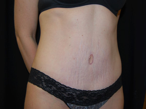 Tummy Tuck Before & After Patient #24425