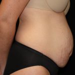 Tummy Tuck Before & After Patient #24425