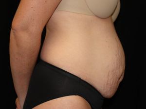 Tummy Tuck Before & After Patient #24425