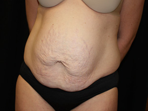 Tummy Tuck Before & After Patient #24425