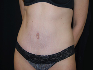 Tummy Tuck Before & After Patient #24425