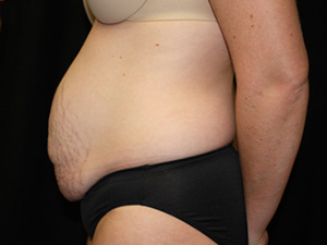 Tummy Tuck Before & After Patient #24425