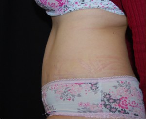 Tummy Tuck Before & After Patient #24449