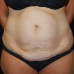 Tummy Tuck Before & After Patient #24449