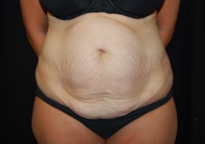 Tummy Tuck Before & After Patient #24449