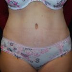 Tummy Tuck Before & After Patient #24449