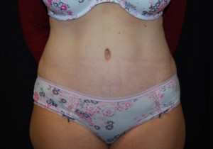 Tummy Tuck Before & After Patient #24449