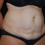 Tummy Tuck Before & After Patient #24449