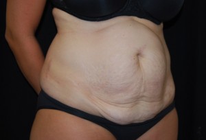 Tummy Tuck Before & After Patient #24449