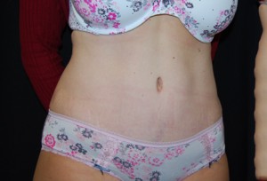 Tummy Tuck Before & After Patient #24449