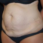 Tummy Tuck Before & After Patient #24449