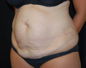 Tummy Tuck Before & After Patient #24449