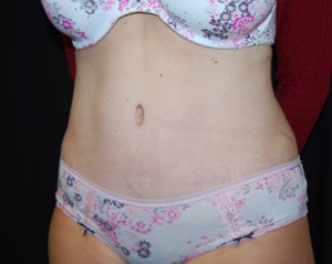 Tummy Tuck Before & After Patient #24449