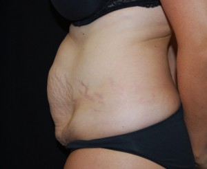 Tummy Tuck Before & After Patient #24449