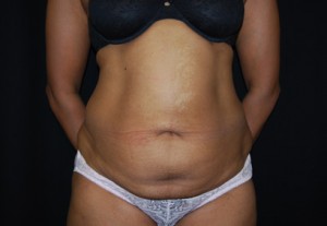 Tummy Tuck Before & After Patient #24448