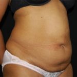 Tummy Tuck Before & After Patient #24448