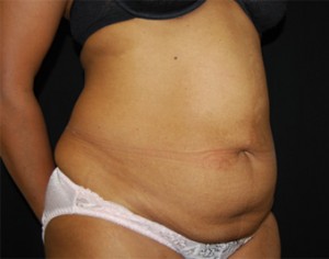 Tummy Tuck Before & After Patient #24448