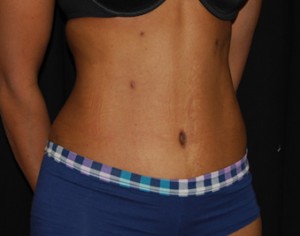 Tummy Tuck Before & After Patient #24448