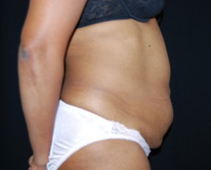 Tummy Tuck Before & After Patient #24448