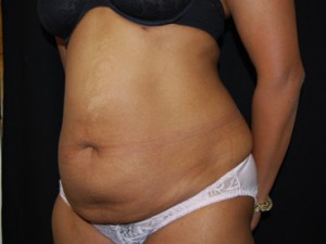 Tummy Tuck Before & After Patient #24448