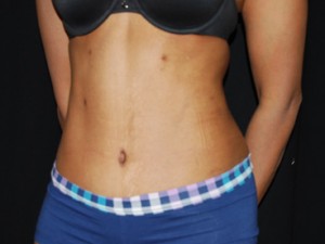Tummy Tuck Before & After Patient #24448