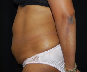 Tummy Tuck Before & After Patient #24448