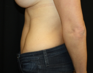 Tummy Tuck Before & After Patient #24450